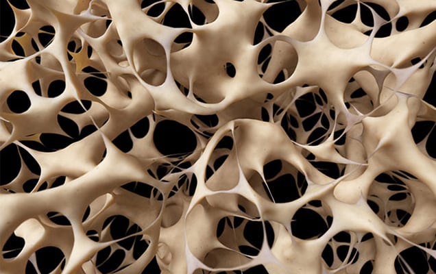 Osteoporosis-Tustin-Orthopedic