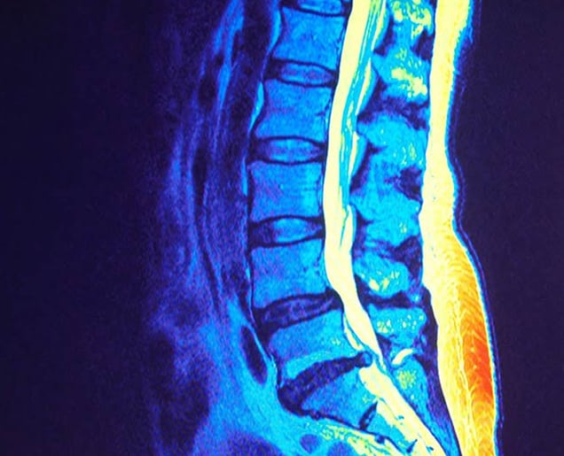 Spinal-Stenosis-Tustin-Orthopedic-2