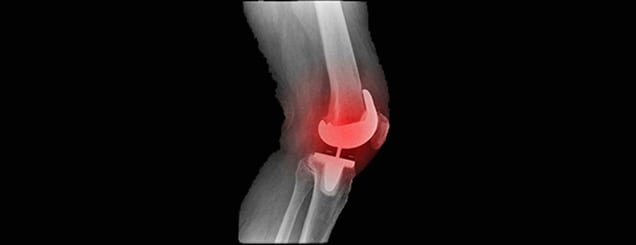 Total-Knee-Replacement-Tustin-Orthopedic-2