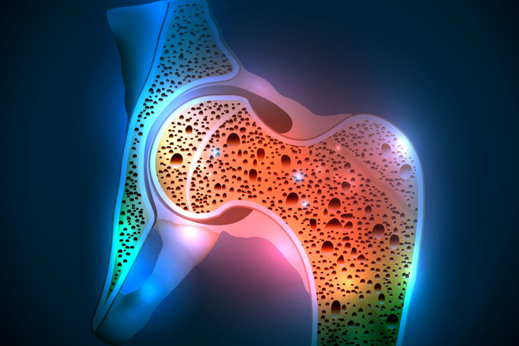 Causes-of-Osteoporosis-Orange-County-Orthopedic-Clinic