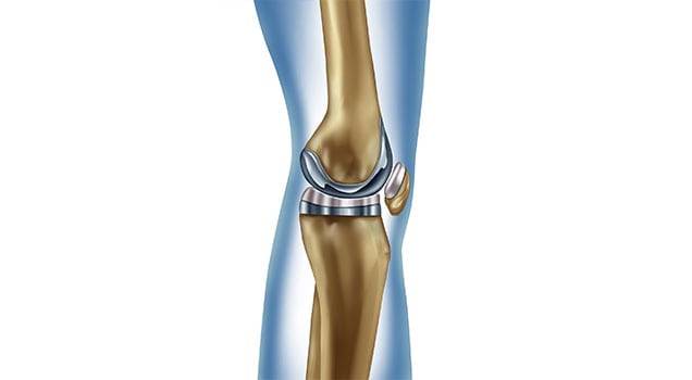 Outpatient-Total-Joint-Replacement-Orange-County-Orthopedic-Clinic-3