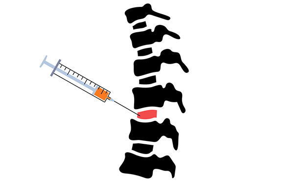 Epidural-Steroid-Therapy--Cervical,-Thoracic,-Lumbar-Spine