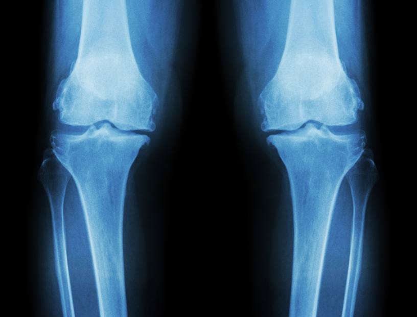 Hemi-Joint-Replacement-Orange-County-Orthopedic-Clinic