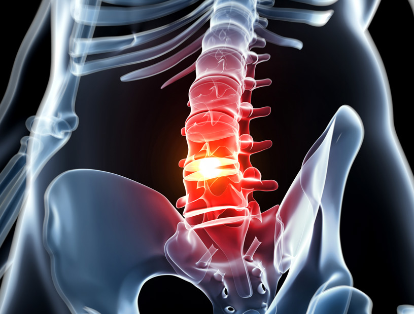 Herniated-Disc-Orange-County-Orthopedic-Clinic