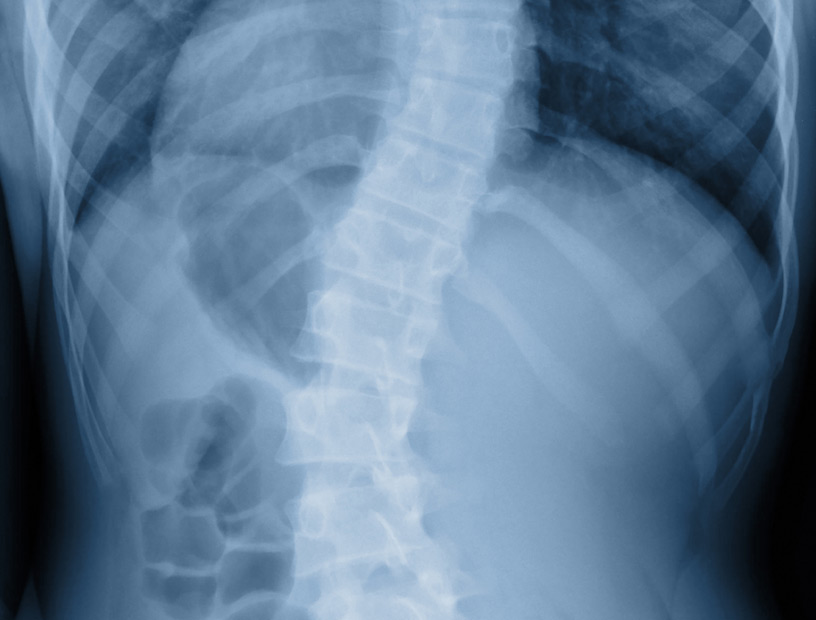 Scoliosis-Orange-County-Orthopedic-Clinic