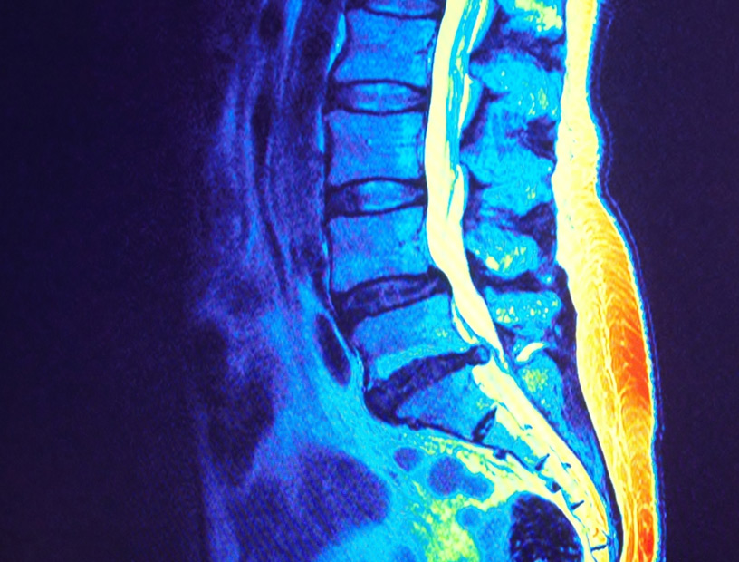 Spinal-Stenosis-Orange-County-Orthopedic-Clinic