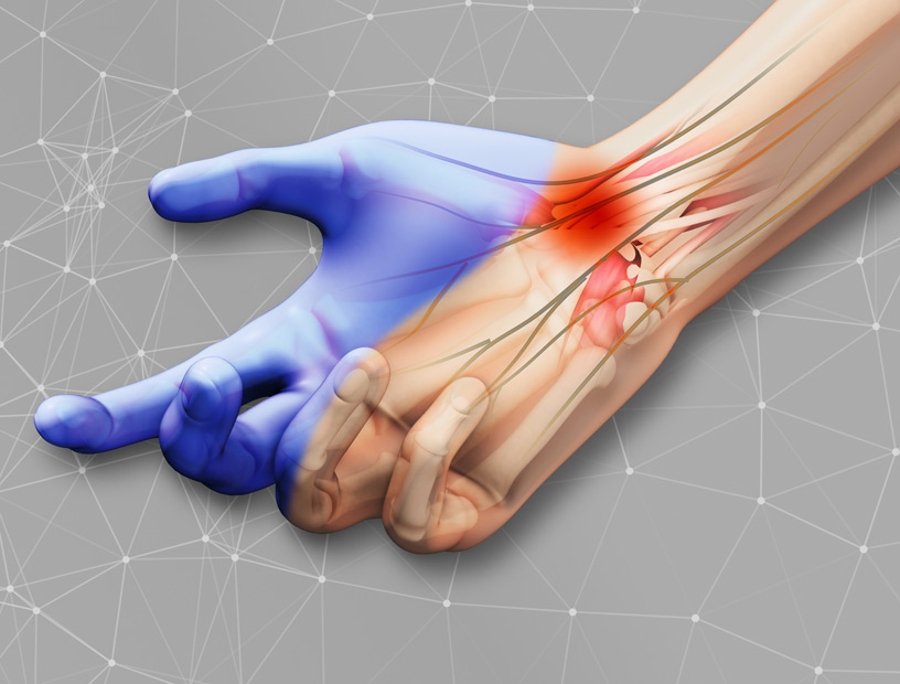 carpal-tunnel-syndrome-with-plexus-background