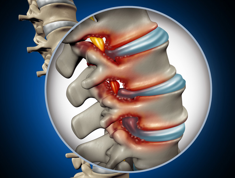 concept-of-spinal-stenosis