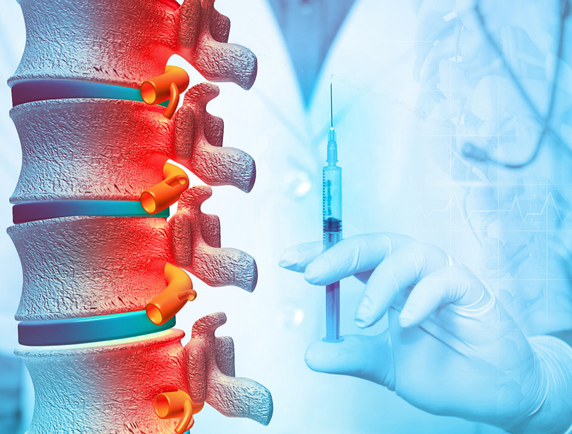 illustration-of-epidural-injection