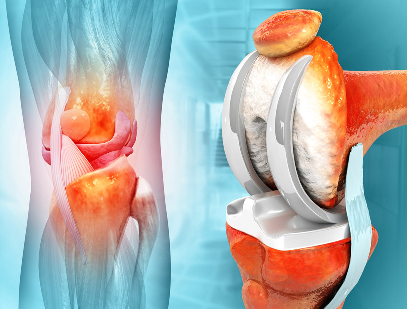 illustration-of-knee-joint-replacement