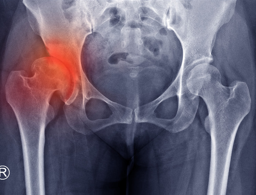 radiograph-showing-developmental-dysplasia